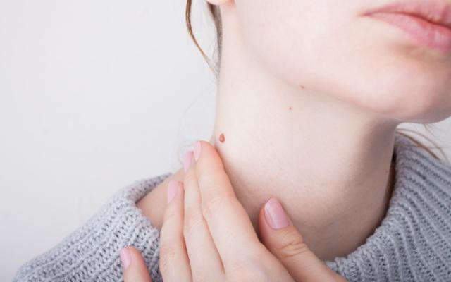 Métodos naturales para eliminar verrugas en el cuello.