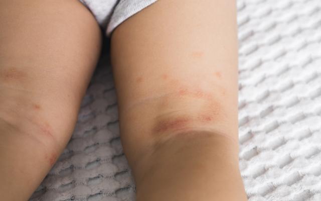 Bebé con manchas rojas en la piel