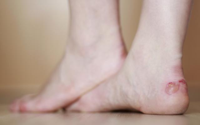 Persona con ampolla en los pies