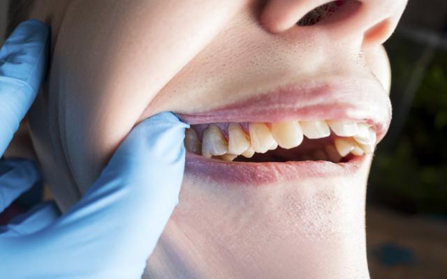 Dentista revisa sarro en los dientes