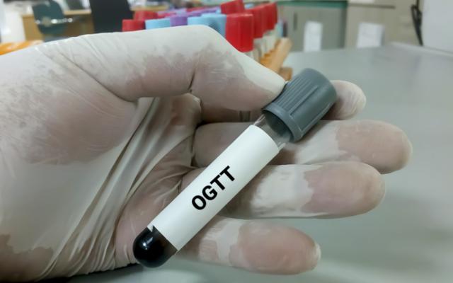 Médico con muestra de tolerancia oral a la glucosa